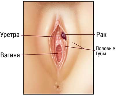 Почему У Девушек Большие Половые Губы Фото